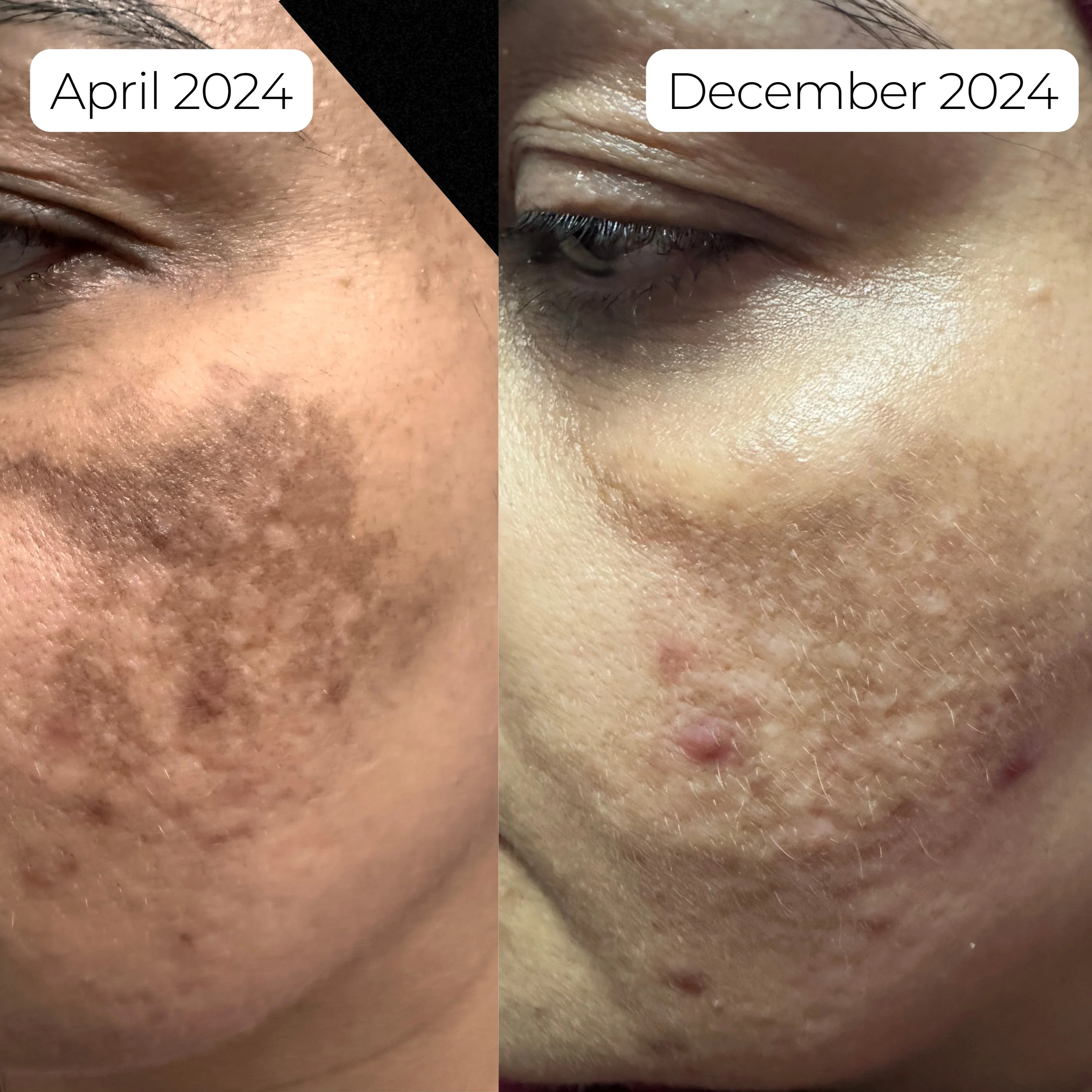 Facial Pigmentation Kit - Image 8